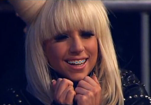 Lady Gaga with braces