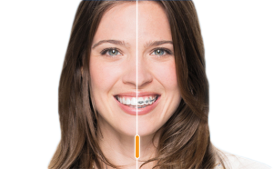 Invisalign vs braces