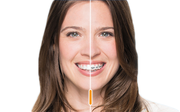 Invisalign vs braces