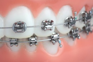 Close up braces