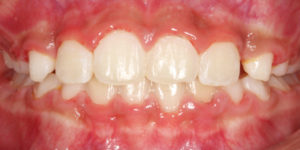 After Photo from before and after braces gallery