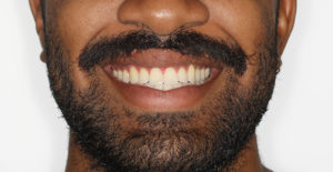 Final Smile