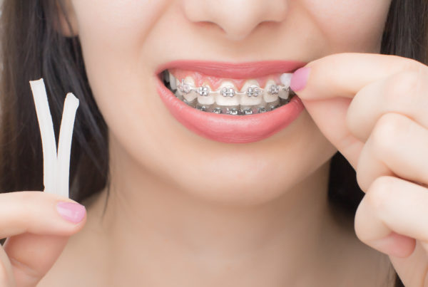 Applying orthodontic wax on the dental braces. Brackets on the teeth after whitening. Self-ligating brackets with metal ties and gray elastics or rubber bands for perfect smile.