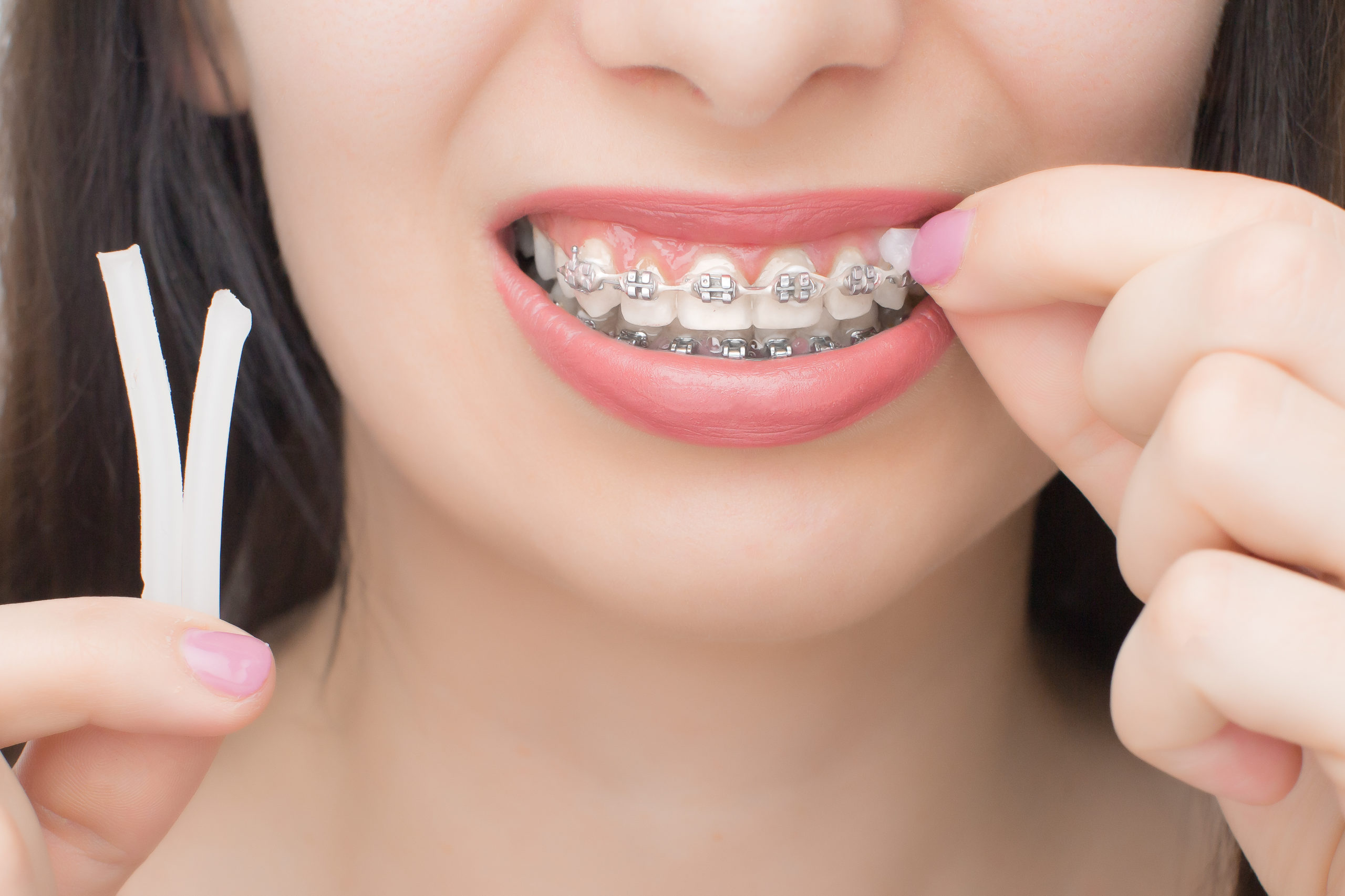 Applying orthodontic wax on the dental braces. Brackets on the teeth after whitening. Self-ligating brackets with metal ties and gray elastics or rubber bands for perfect smile.