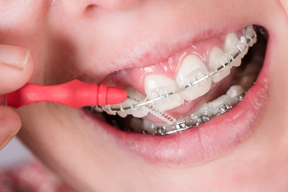 All About Ceramic Braces - Stellar Family Orthodontics