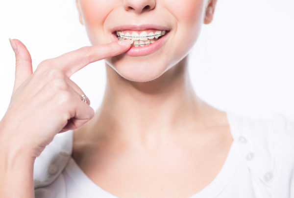 what is an overbite and how it is fixed