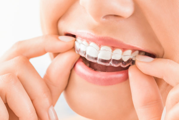 first week of invisalign