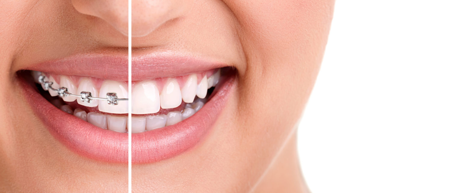Can I Whiten My Teeth With Braces? Fresh Orthodontics Brooklyn NY