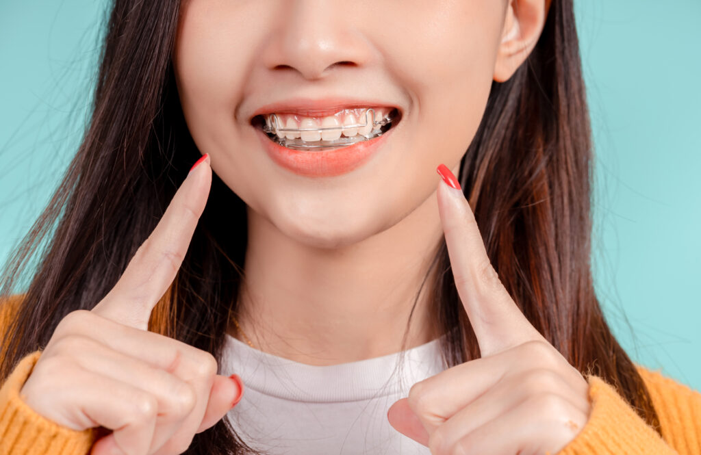 When Can I Stop Wearing My Retainer? Fresh Orthodontics