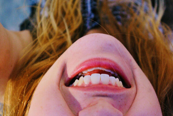 A girl smiling upside down with crowded teeth