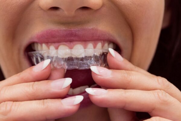 A close up of a woman inserting clear aligners for a post on the dangers of at-home teeth aligners