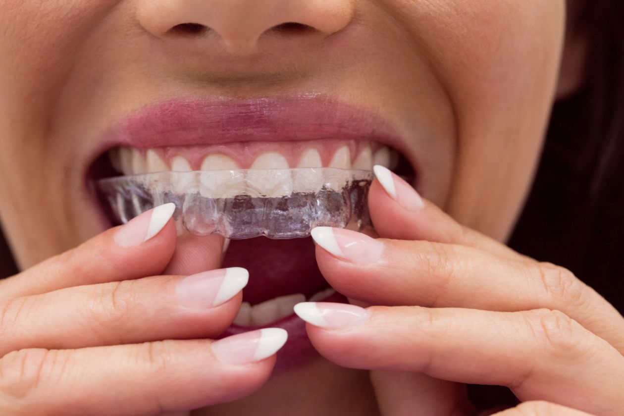 A close up of a woman inserting clear aligners for a post on the dangers of at-home teeth aligners